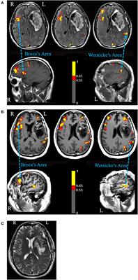 Functional Translocation of Broca's Area in a Low-Grade Left Frontal Glioma: Graph Theory Reveals the Novel, Adaptive Network Connectivity